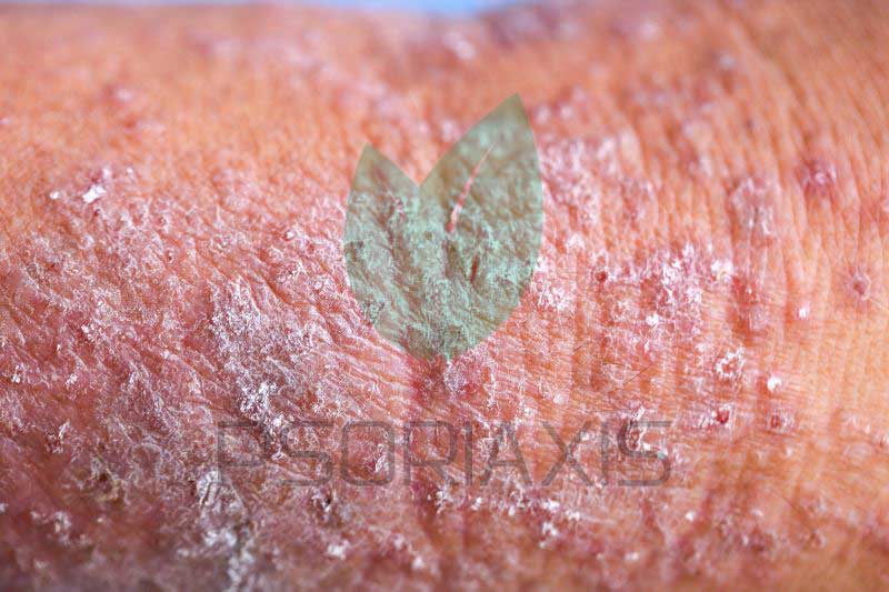 Atopijski dermatitis