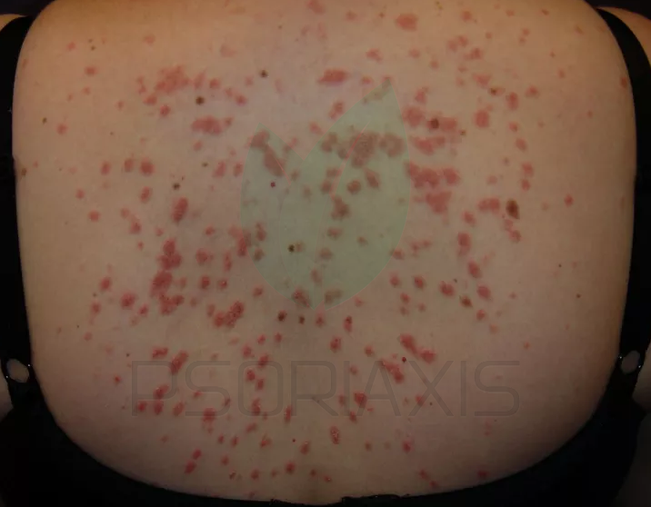 Kapljičasta/Guttate psorijaza 