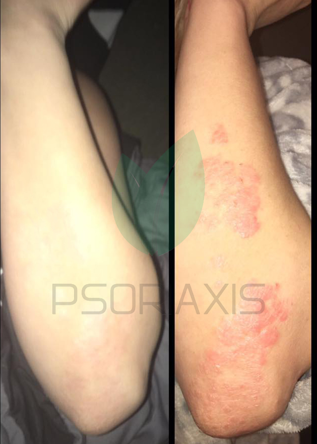 Krema protiv psorijaze