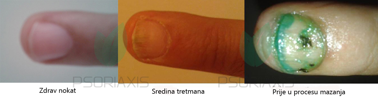 Psorijaza na noktima