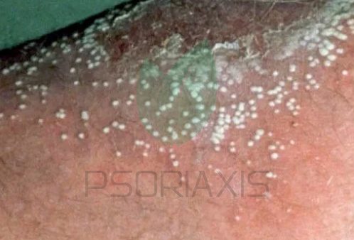 Pustolozna psorijaza